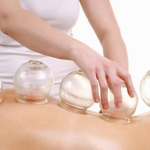 Cupping Treatment in Missoula, MT | Acupuncture Universal